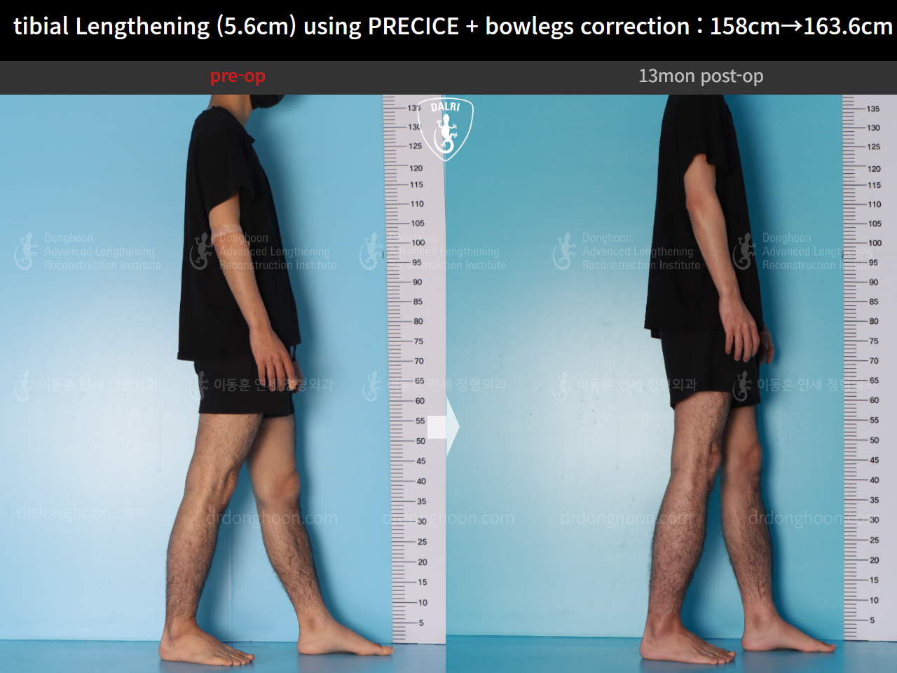 Before and after cll precice, case 16213622, image 6, Dr. Donghoon institute (DALRI)