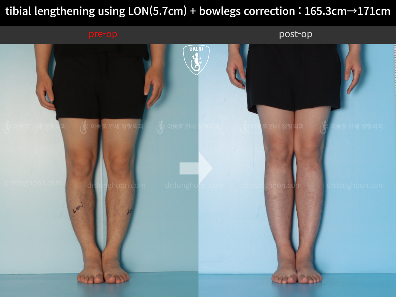 Before and after cll + deformity correction, case 12679153, image 5, Dr. Donghoon institute (DALRI)