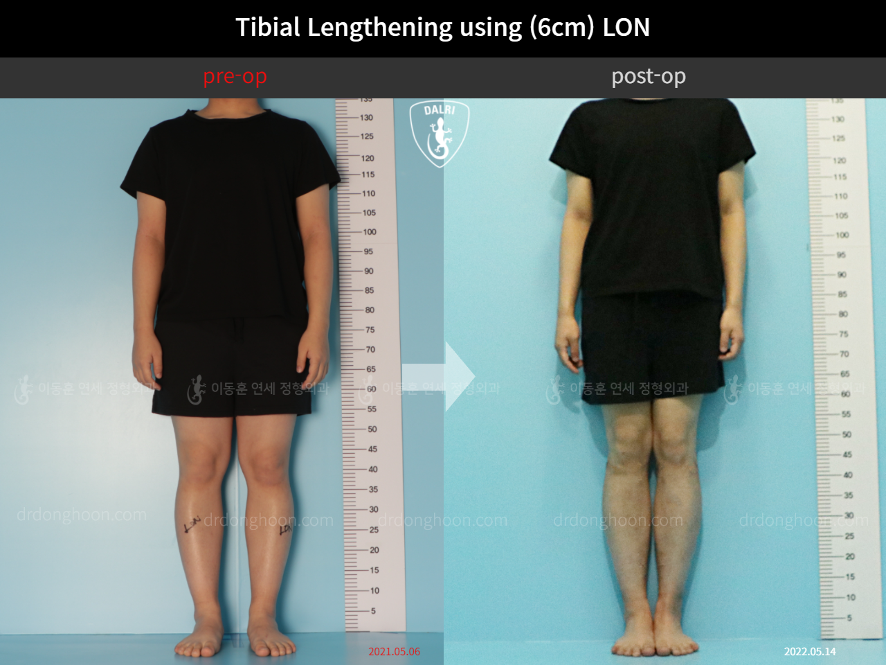 Before and after cll lon, case 11511553, image 1, Dr. Donghoon institute (DALRI)