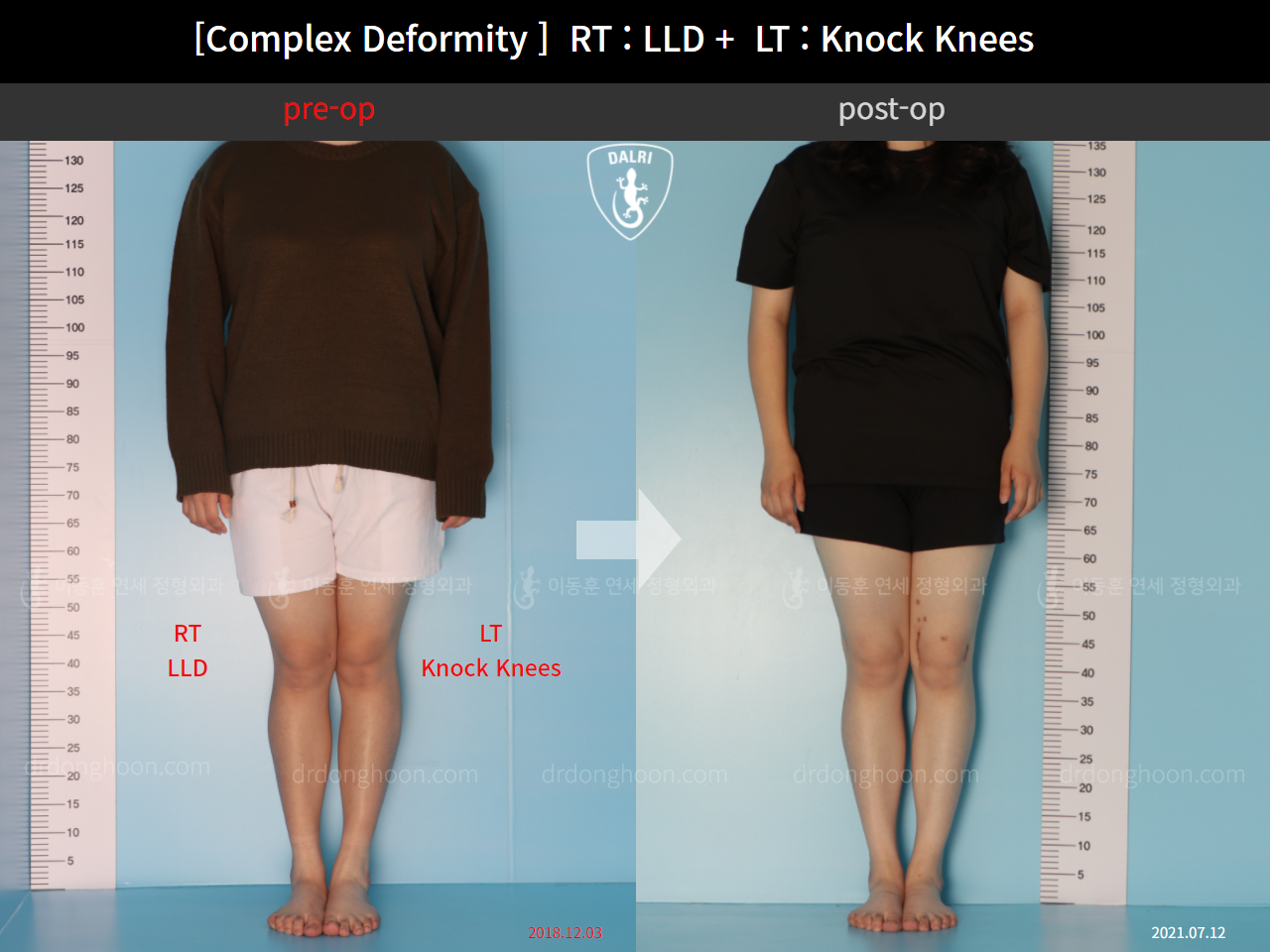 Before and after adult lld, case 10524998, image 3, Dr. Donghoon institute (DALRI)
