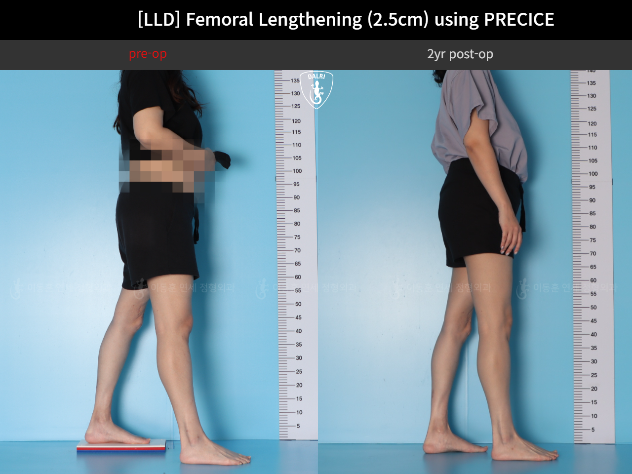 Before and after adult lld, case 89087135, image 4, Dr. Donghoon institute (DALRI)