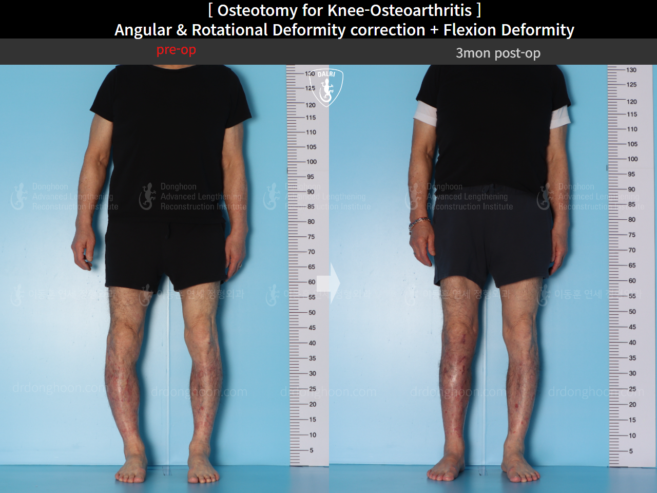 Before and after osteotomy for knee osteoarthritis, case 15362950, image 3, Dr. Donghoon institute (DALRI)