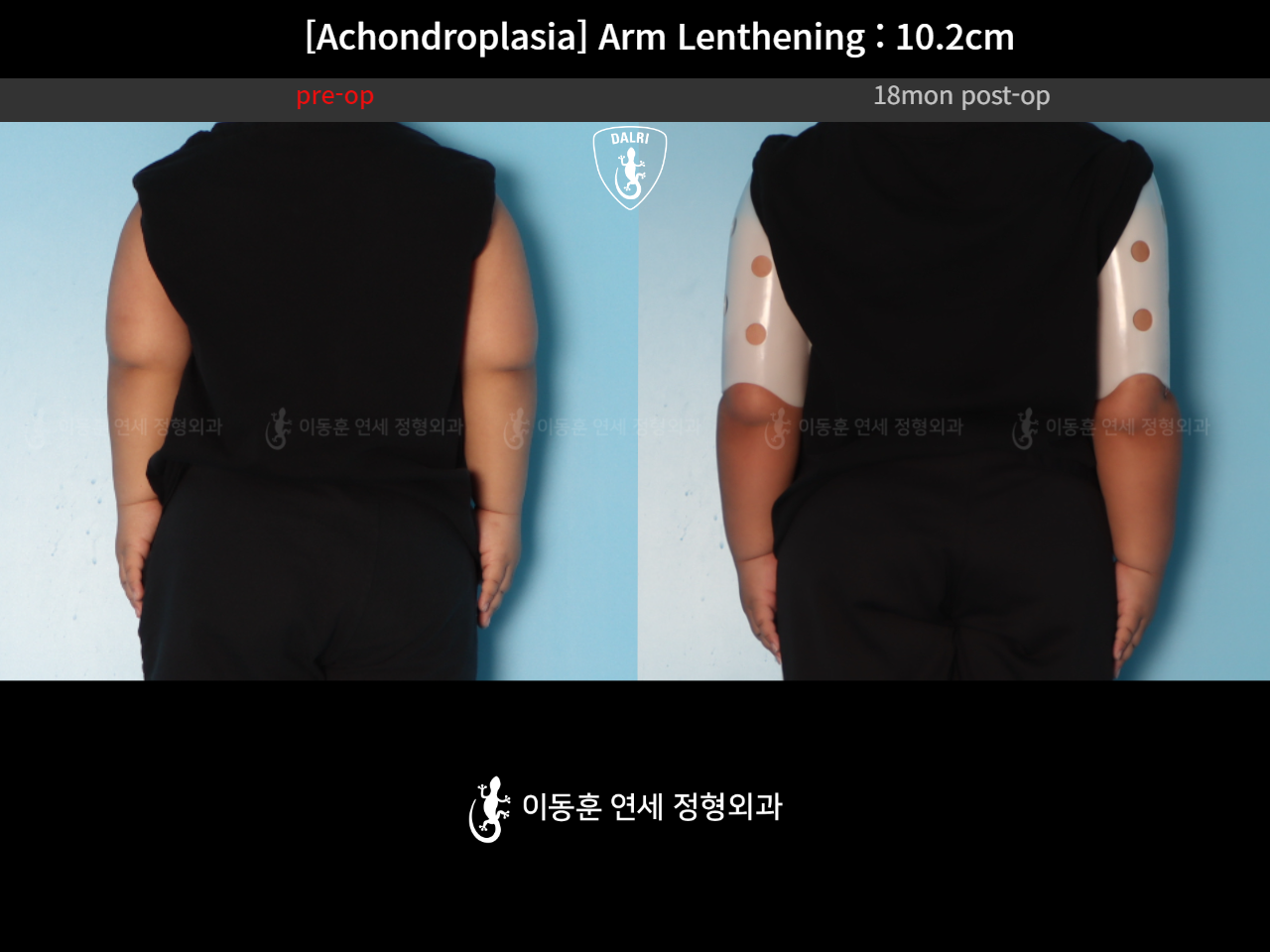 Before and after arm lengthening, case 38474065, image 3, Dr. Donghoon institute (DALRI)