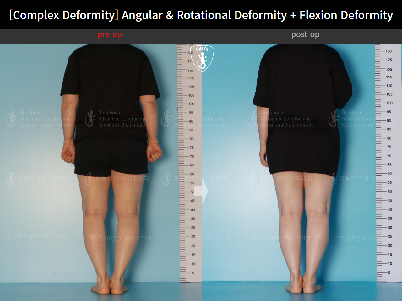 Before and after adult bowlegs, case 16781344, image 4, Dr. Donghoon institute (DALRI)