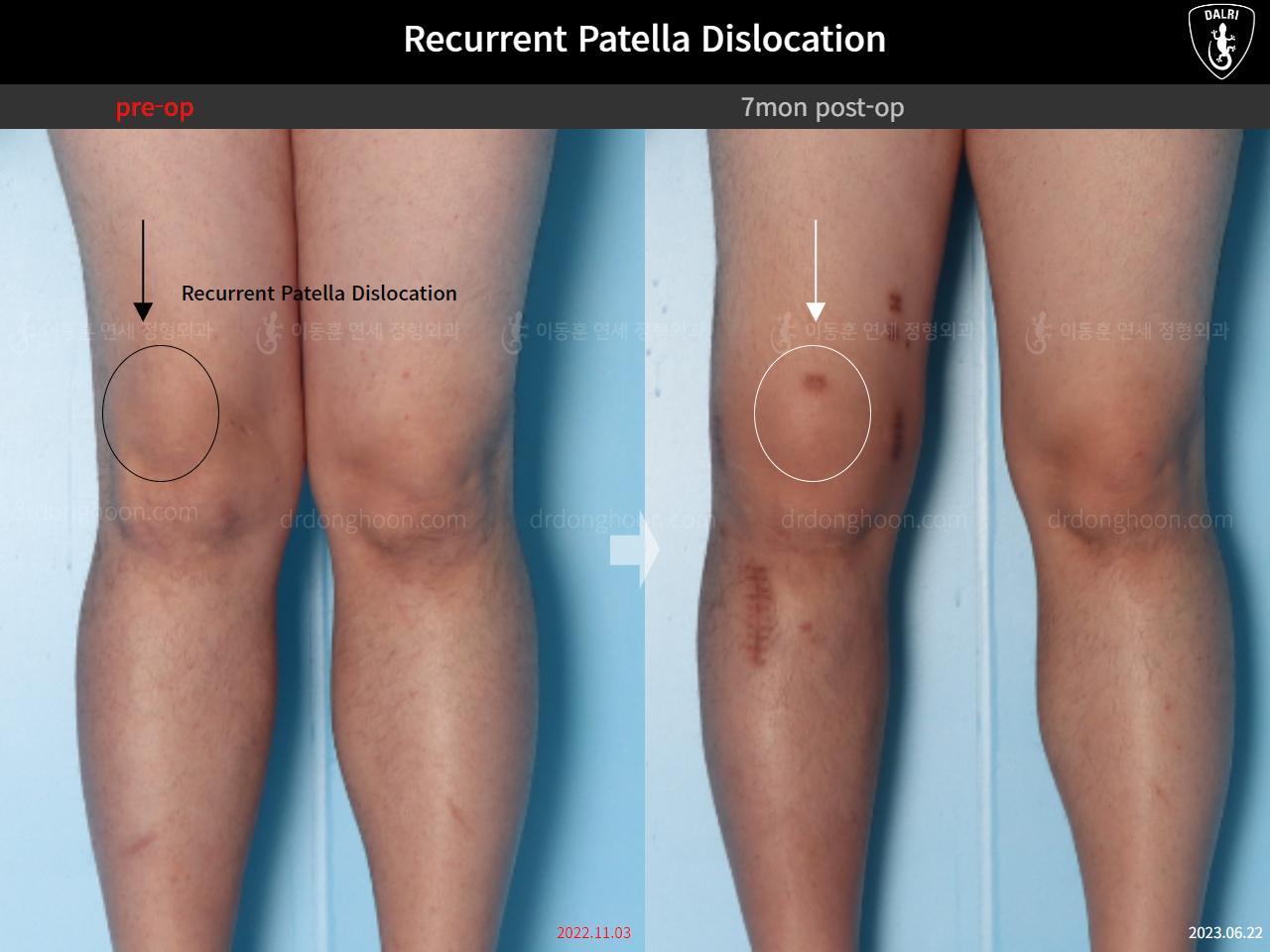 Before and after recurrent patella dislocation, case 16147031, image 16, Dr. Donghoon institute (DALRI)