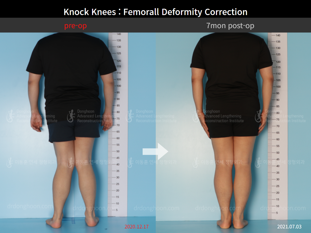 Before and after adult knock knees, case 8821218, image 4, Dr. Donghoon institute (DALRI)