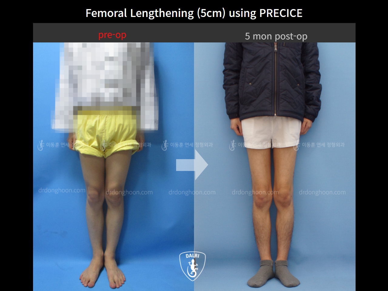 Before and after cll precice, case 9231745, image 2, Dr. Donghoon institute (DALRI)