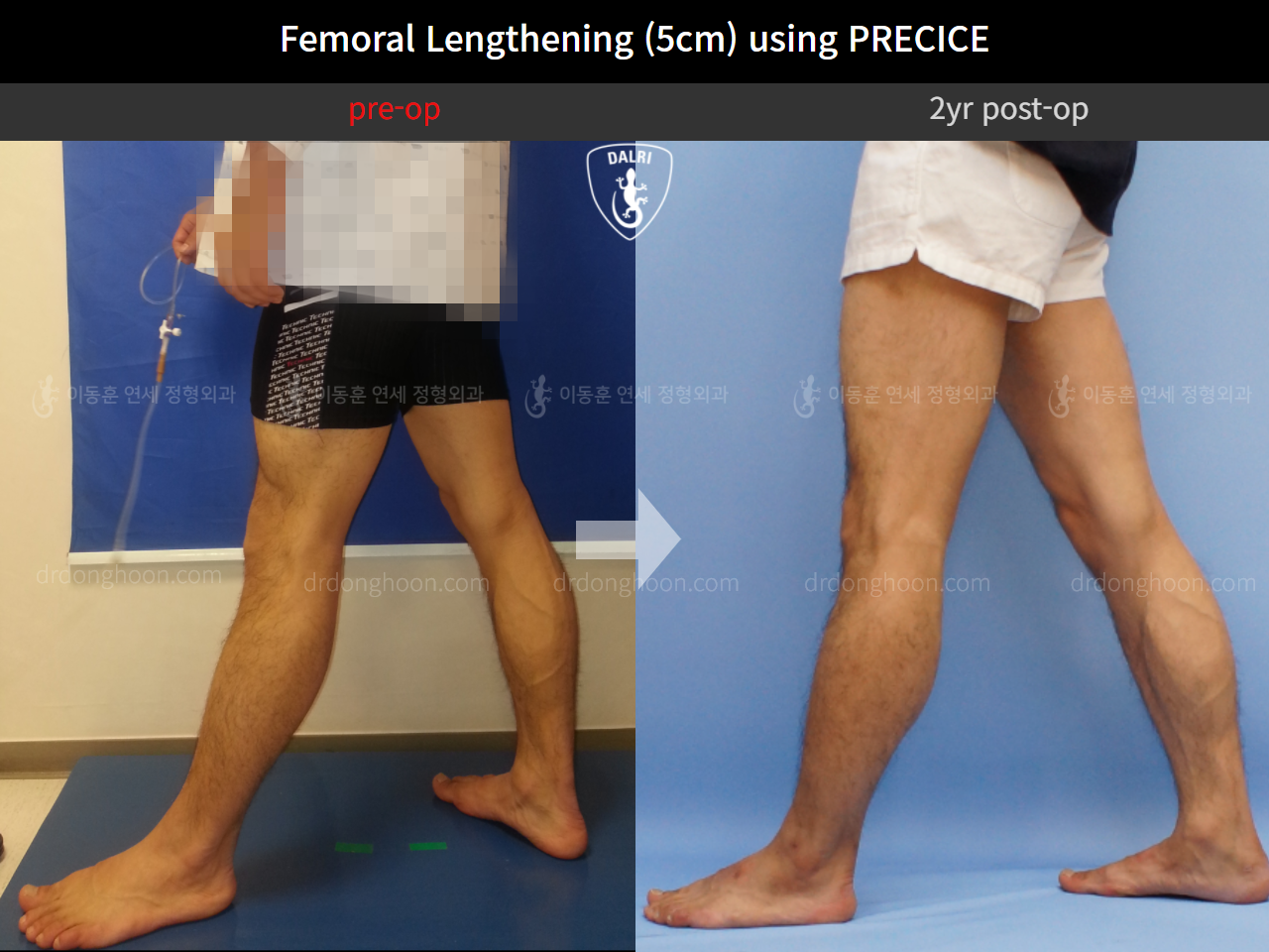 Before and after cll precice, case 4323372, image 6, Dr. Donghoon institute (DALRI)