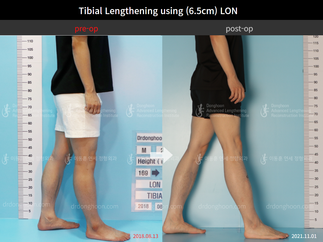 Before and after cll lon, case 8777040, image 7, Dr. Donghoon institute (DALRI)