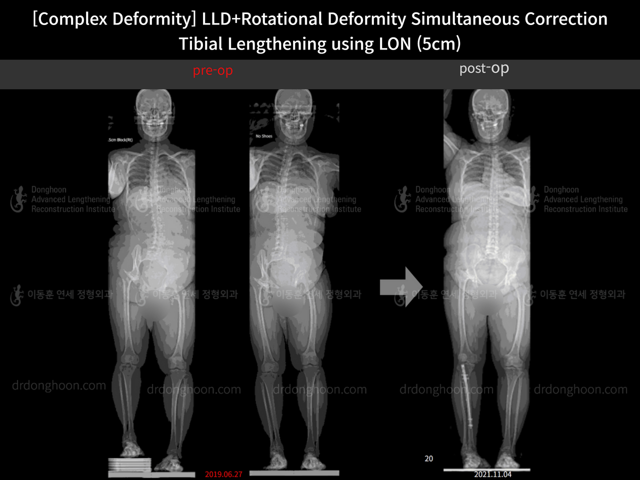 Before and after complex deformity, case 12278763, image 1, Dr. Donghoon institute (DALRI)