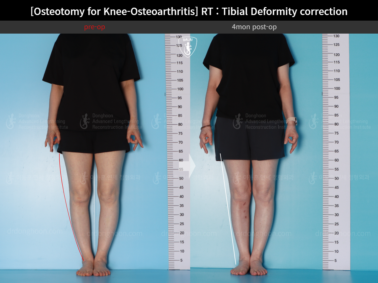 Before and after osteotomy for knee osteoarthritis, case 17890677, image 1, Dr. Donghoon institute (DALRI)