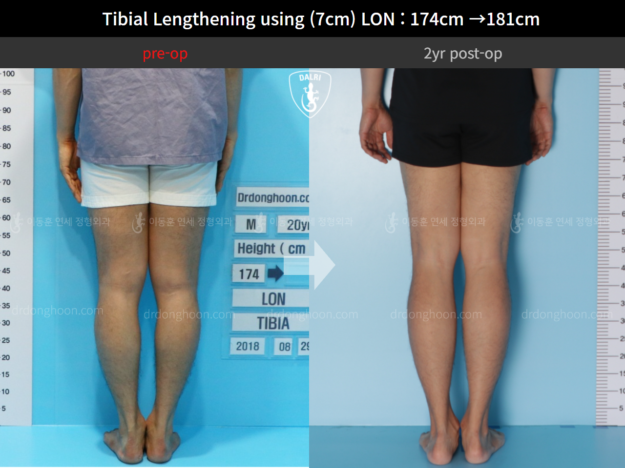 Before and after cll lon, case 5316185, image 6, Dr. Donghoon institute (DALRI)
