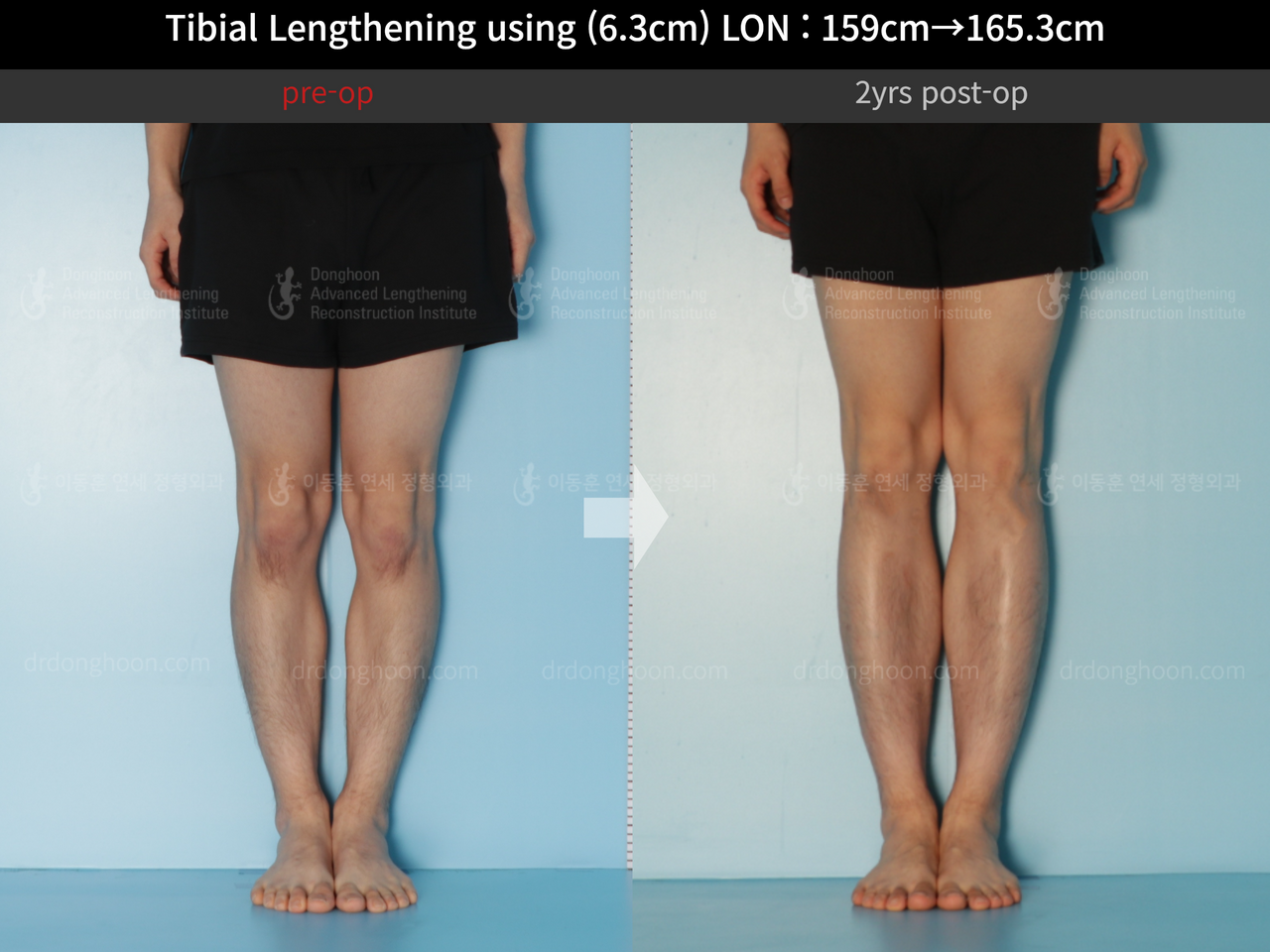 Before and after cll lon, case 12096536, image 7, Dr. Donghoon institute (DALRI)