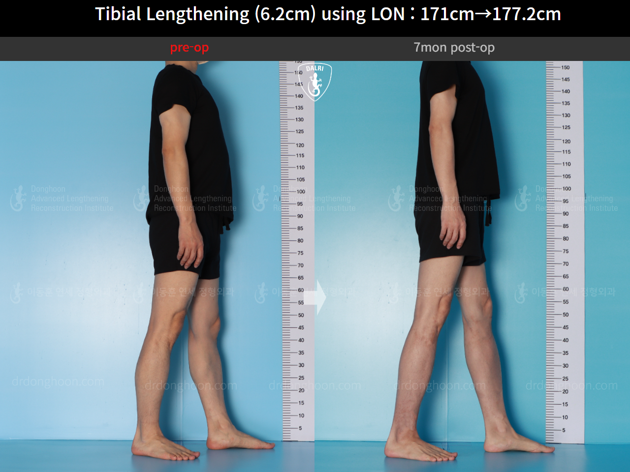 Before and after cll lon, case 16713373, image 7, Dr. Donghoon institute (DALRI)