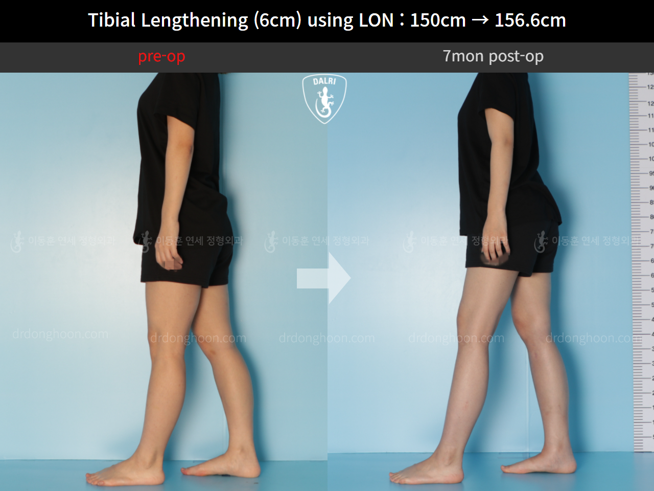 Before and after cll lon, case 9992030, image 3, Dr. Donghoon institute (DALRI)