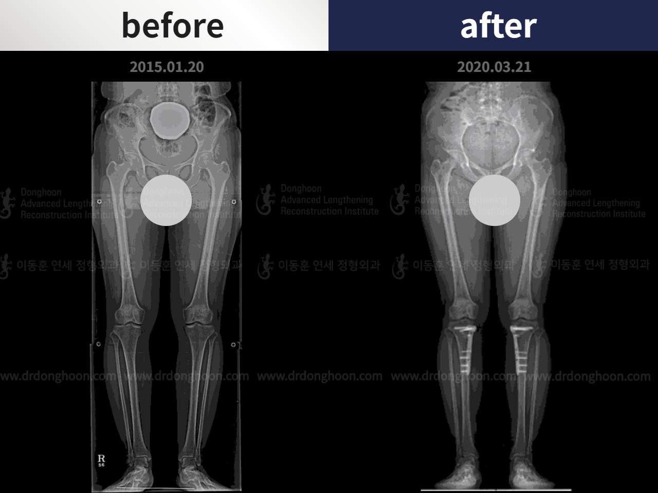 Before and after adult bowlegs, case 4676436, image 3, Dr. Donghoon institute (DALRI)