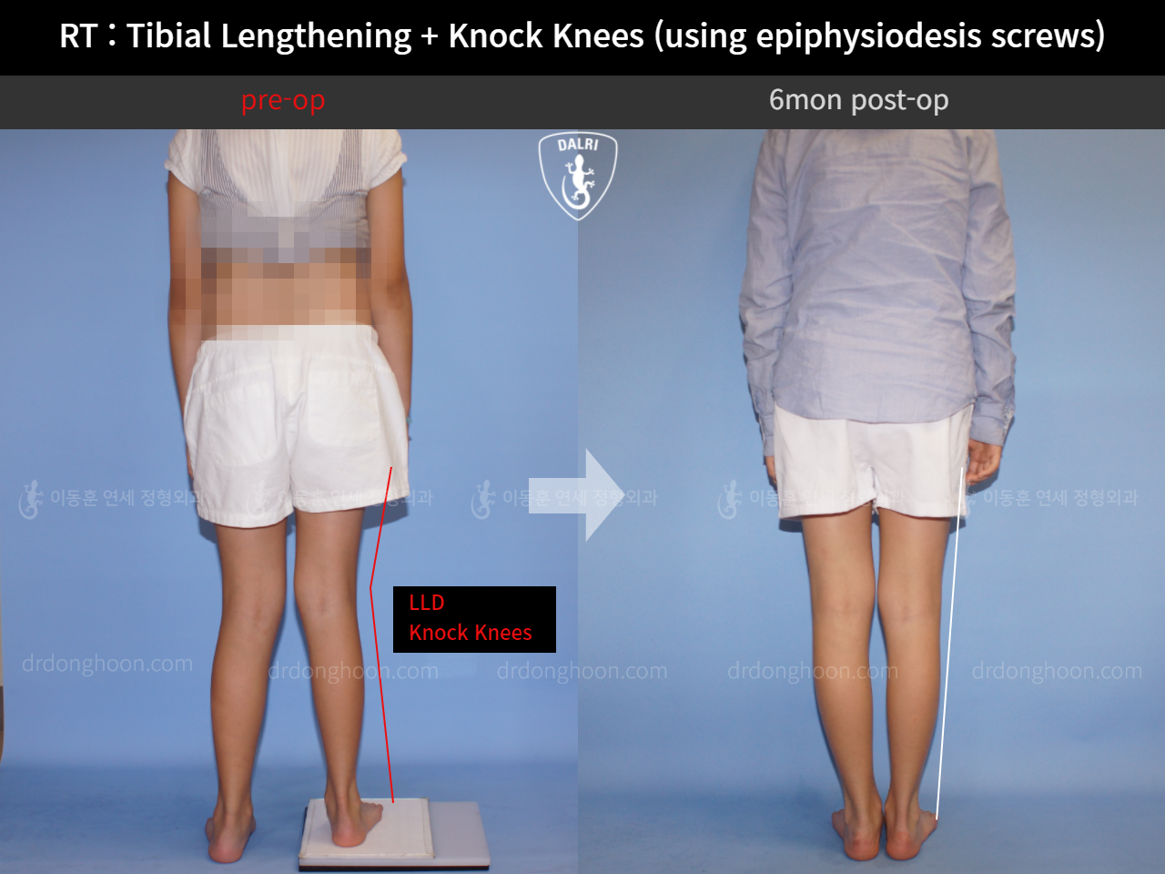 Before and after paediatric & adolescent lld, case 4320397, image 2, Dr. Donghoon institute (DALRI)