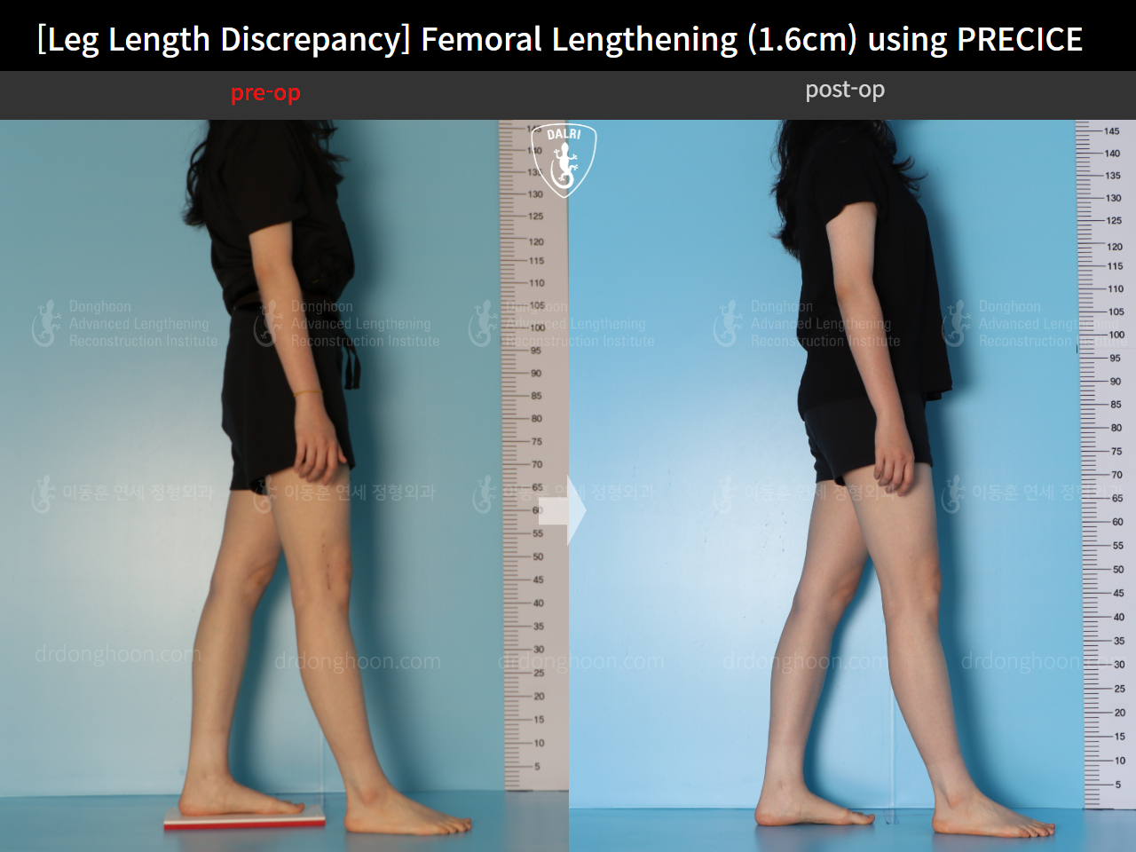 Before and after adult lld, case 15705968, image 5, Dr. Donghoon institute (DALRI)
