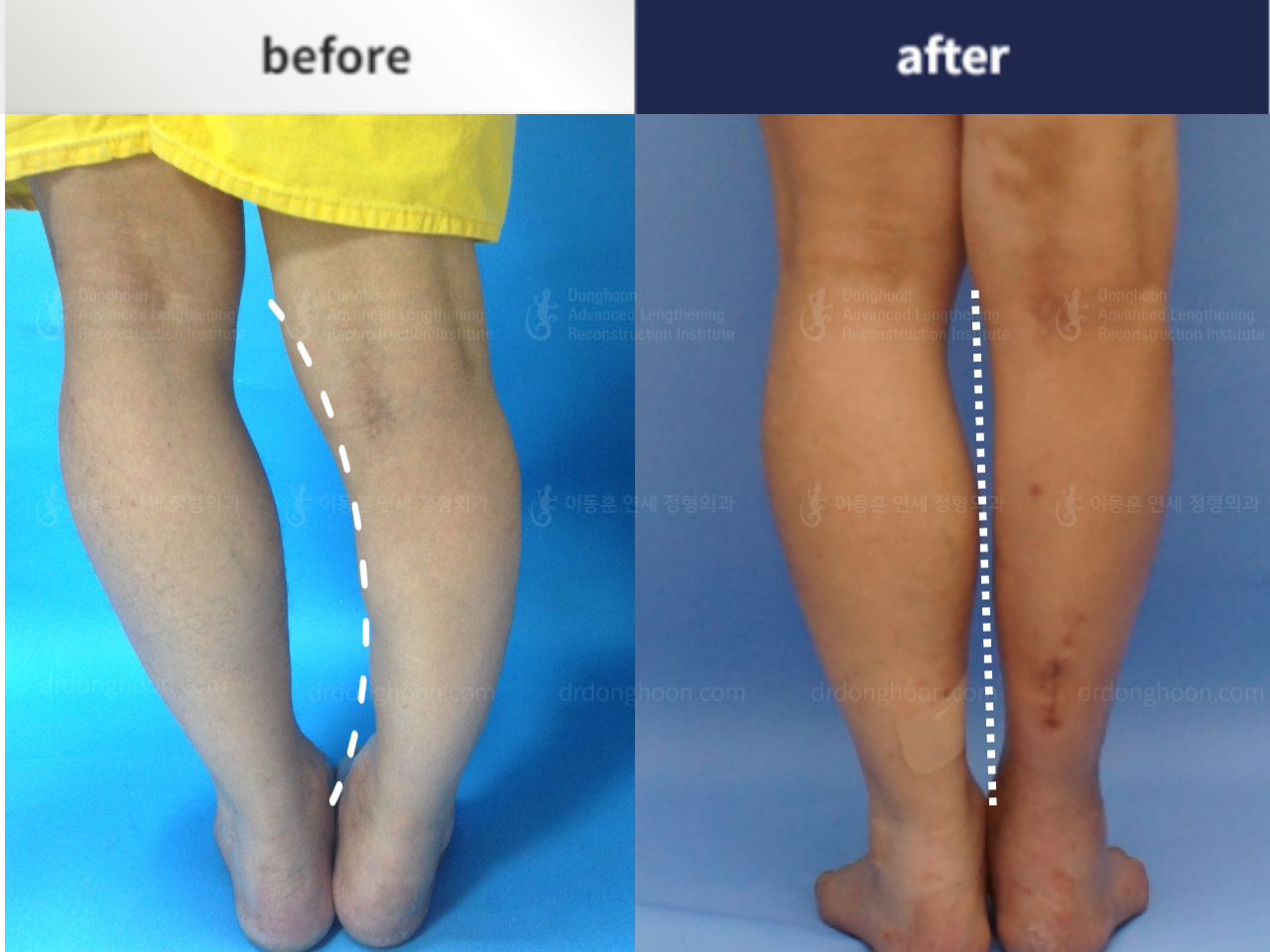 Before and after foot & ankle deformity, case 4248161, image 2, Dr. Donghoon institute (DALRI)