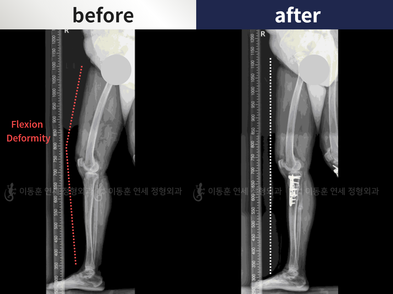 Before and after osteotomy for knee osteoarthritis, case 6007891, image 4, Dr. Donghoon institute (DALRI)