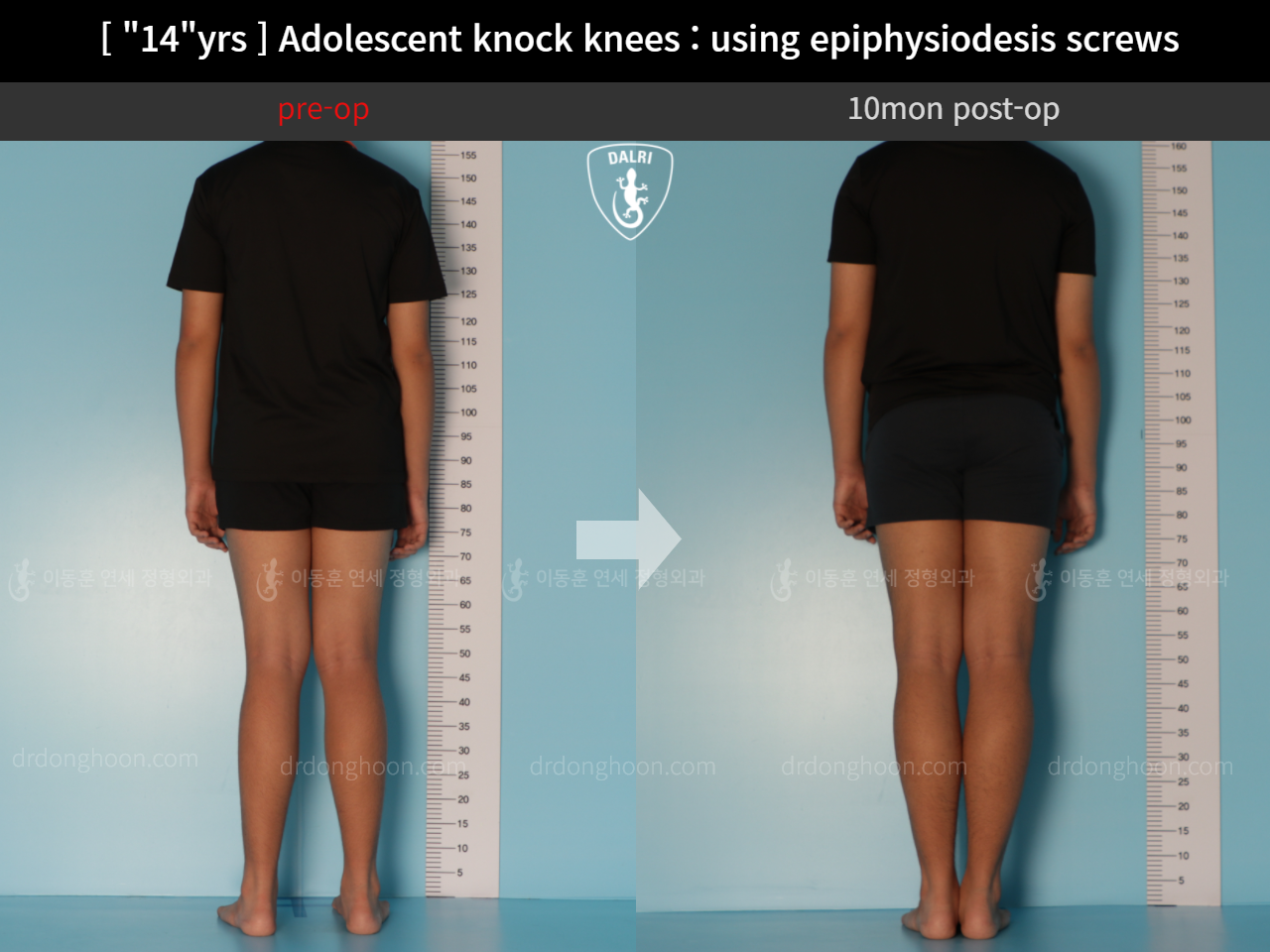 Before and after paediatric & adolescent knock knees, case 11674972, image 2, Dr. Donghoon institute (DALRI)