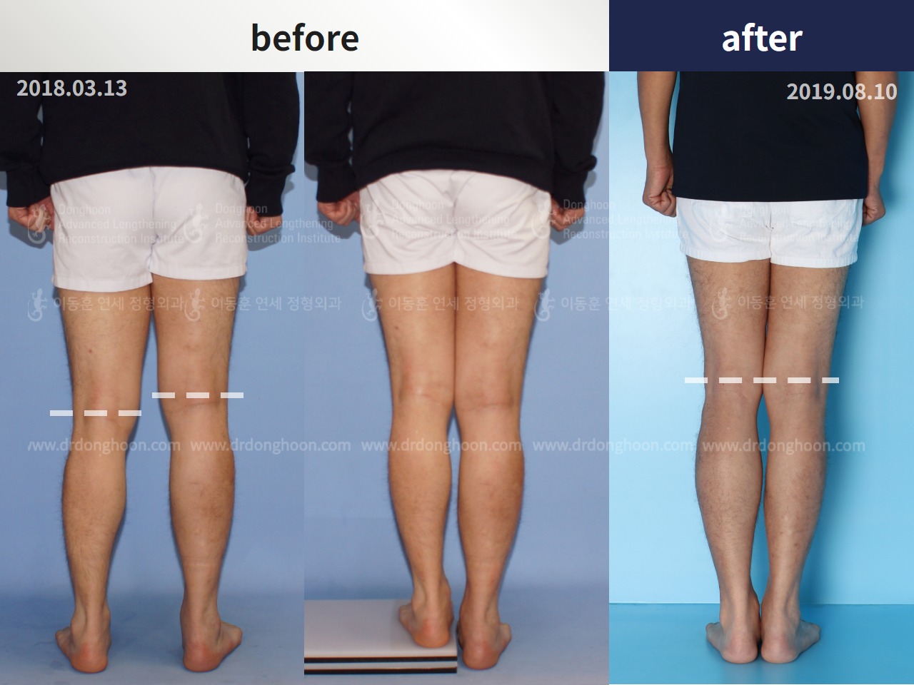 Before and after adult lld, case 4684471, image 2, Dr. Donghoon institute (DALRI)