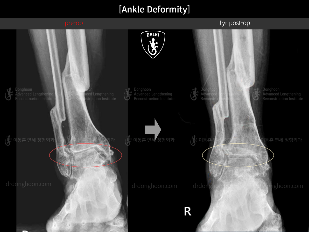 Before and after foot & ankle deformity, case 13580612, image 8, Dr. Donghoon institute (DALRI)
