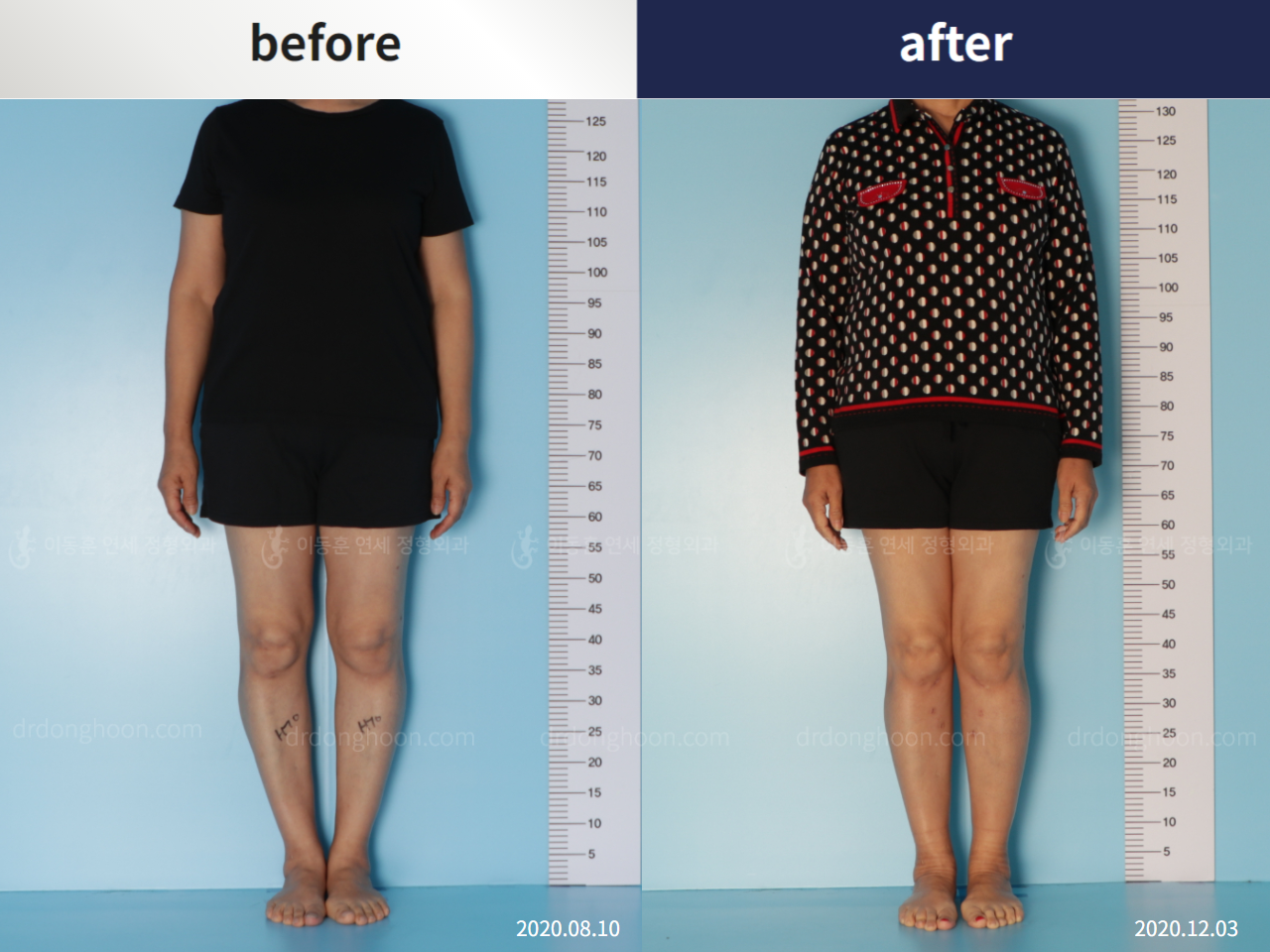 Before and after osteotomy for knee osteoarthritis, case 5455902, image 2, Dr. Donghoon institute (DALRI)