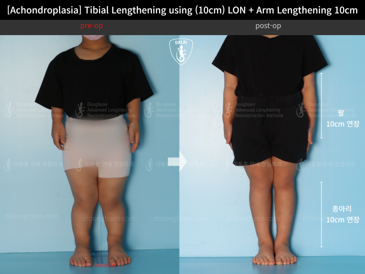 Before and after paediatric congenital condition, case 13864044, image 4, Dr. Donghoon institute (DALRI)