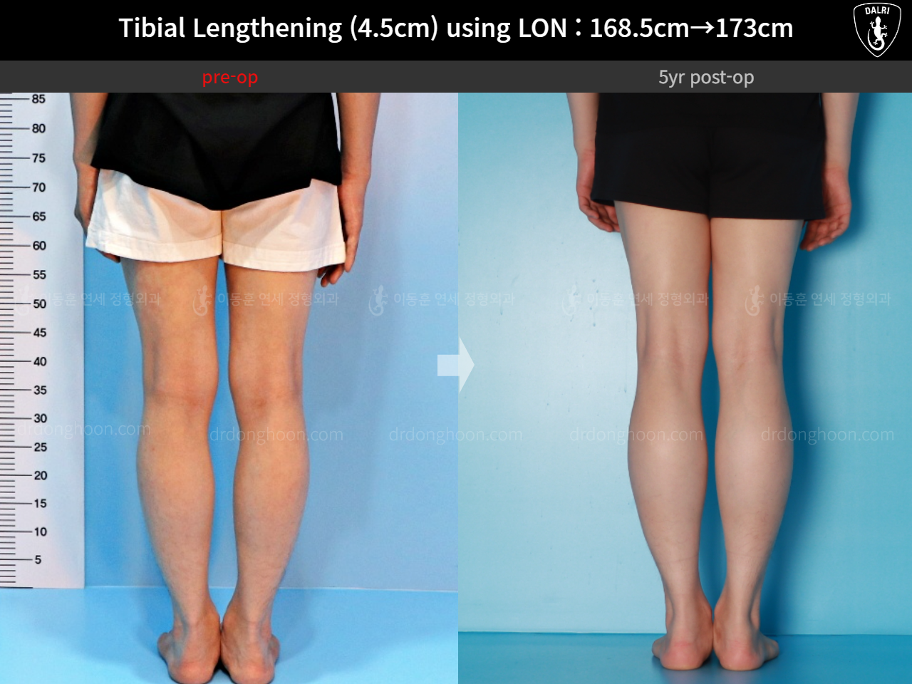 Before and after cll lon, case 16140967, image 8, Dr. Donghoon institute (DALRI)
