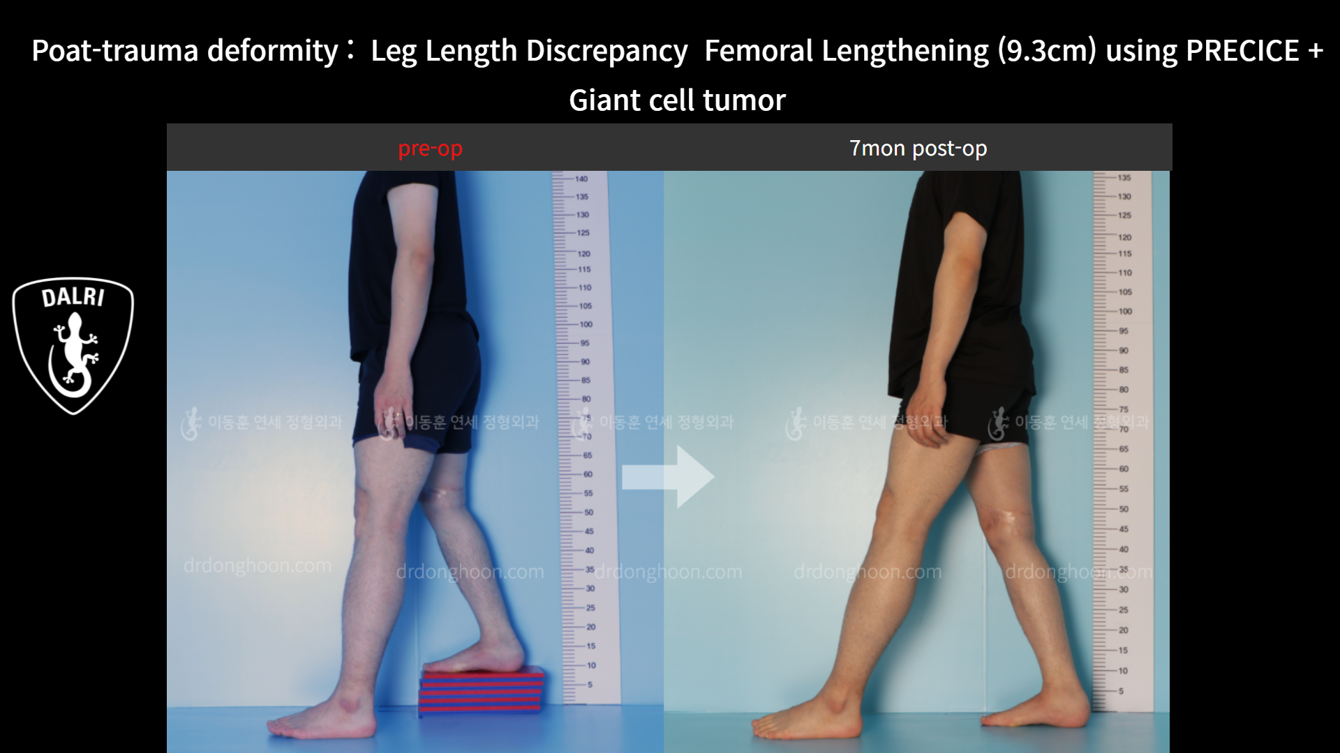 Before and after post-trauma deformity, case 8606746, image 3, Dr. Donghoon institute (DALRI)