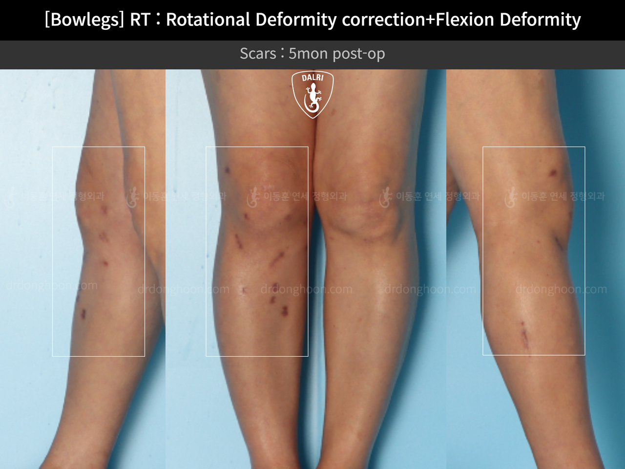 Before and after flexion deformity, case 13668673, image 7, Dr. Donghoon institute (DALRI)