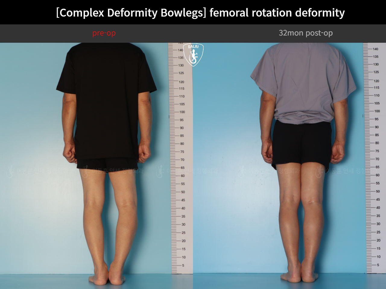 Before and after adult bowlegs, case 35242887, image 6, Dr. Donghoon institute (DALRI)