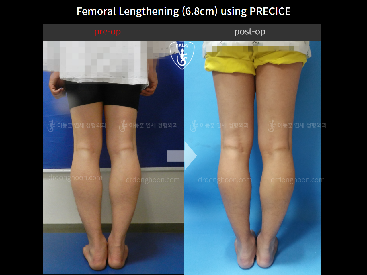 Before and after cll precice, case 4323358, image 2, Dr. Donghoon institute (DALRI)