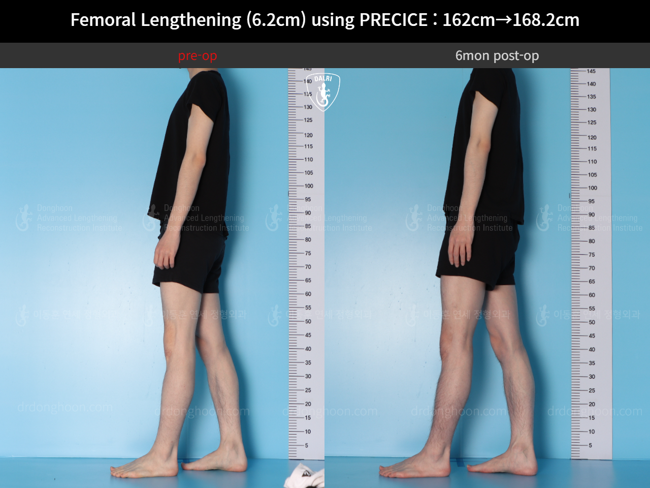 Before and after cll precice, case 15393865, image 7, Dr. Donghoon institute (DALRI)