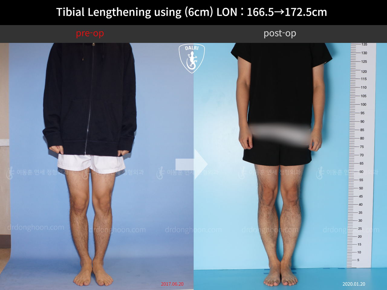 Before and after cll lon, case 11980239, image 1, Dr. Donghoon institute (DALRI)