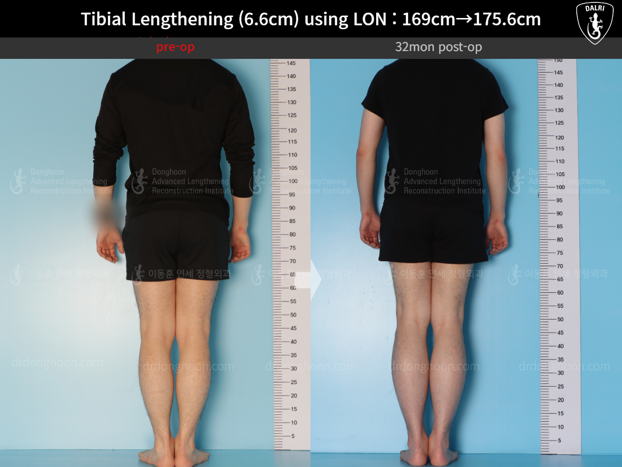 Before and after cll lon, case 15166302, image 6, Dr. Donghoon institute (DALRI)