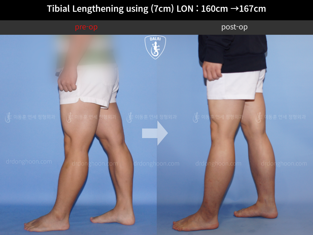Before and after cll lon, case 11283181, image 7, Dr. Donghoon institute (DALRI)