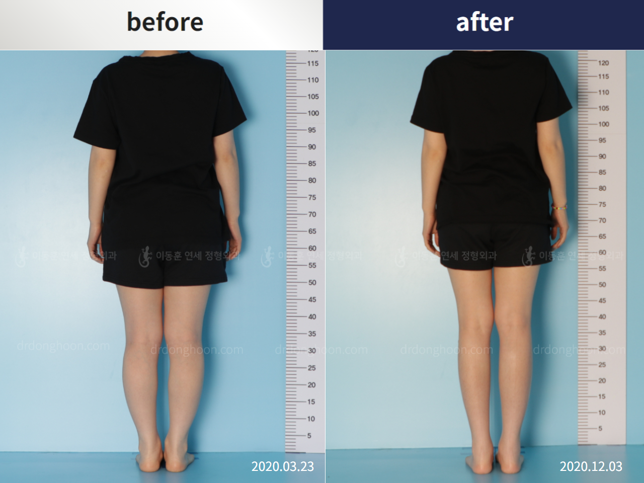 Before and after congenital condition, case 5456690, image 3, Dr. Donghoon institute (DALRI)