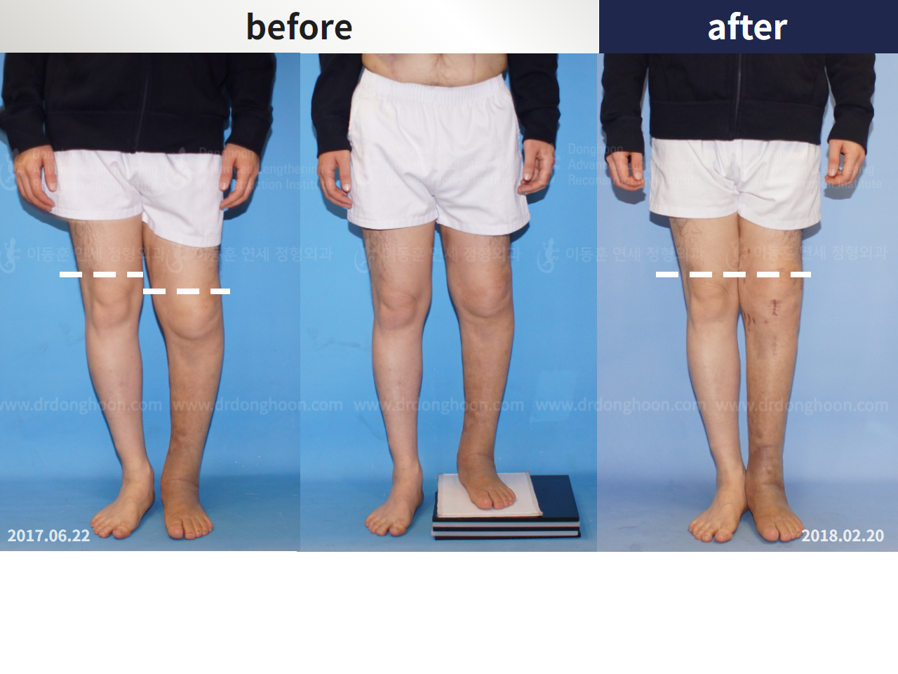 Before and after post-trauma deformity, case 4251791, image 3, Dr. Donghoon institute (DALRI)