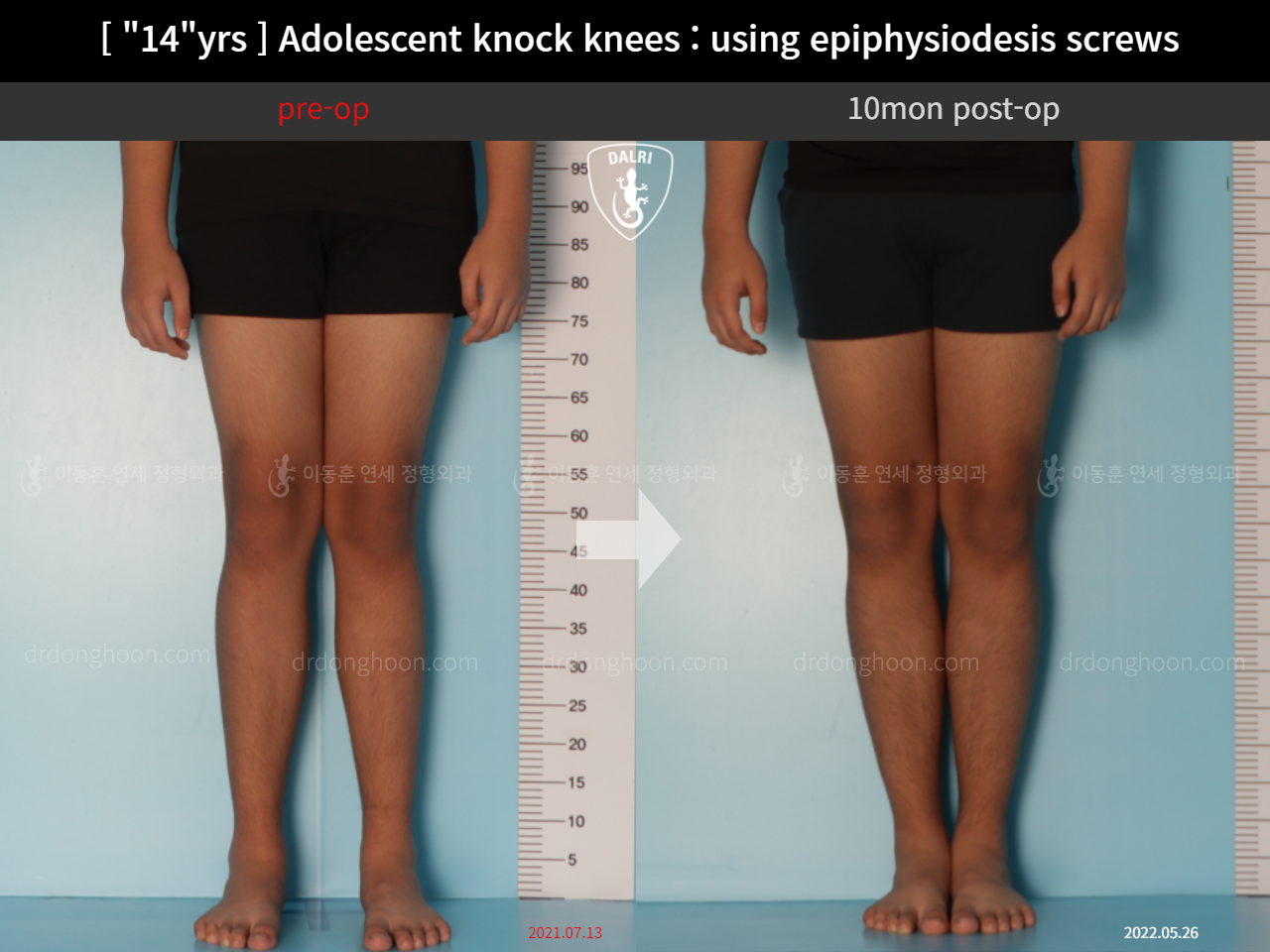 Before and after paediatric & adolescent knock knees, case 11674972, image 3, Dr. Donghoon institute (DALRI)