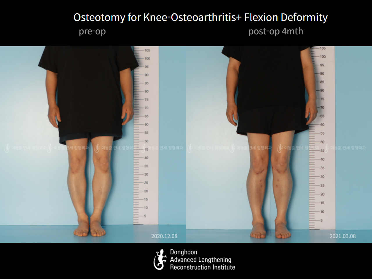 Before and after osteotomy for knee osteoarthritis, case 6754519, image 1, Dr. Donghoon institute (DALRI)