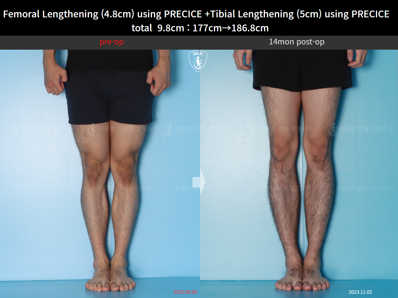 Before and after cll precice, case 16780196, image 7, Dr. Donghoon institute (DALRI)