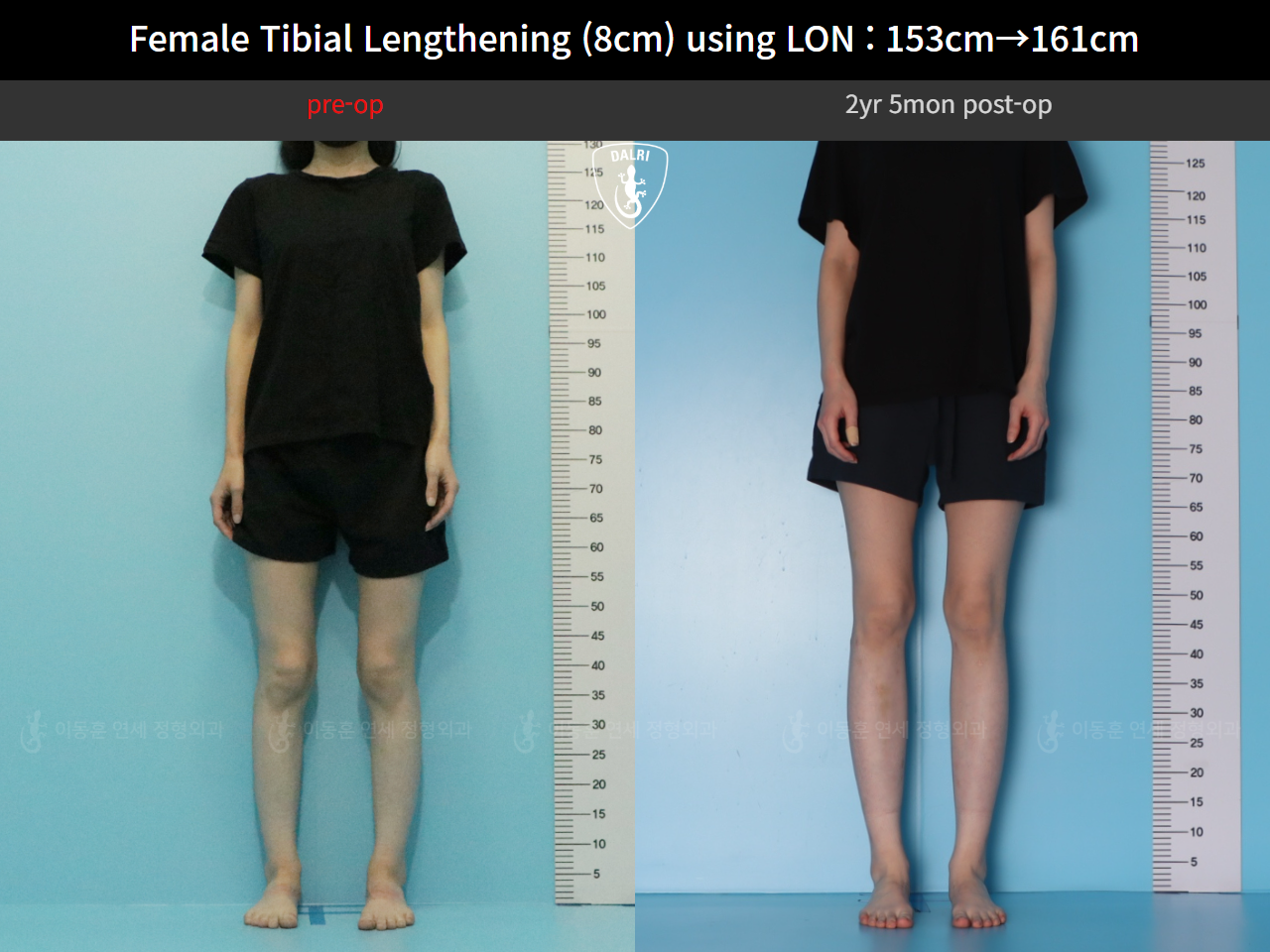 Before and after cll lon, case 128135191, image 2, Dr. Donghoon institute (DALRI)