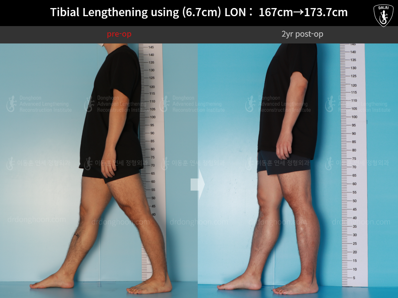 Before and after cll lon, case 16165376, image 4, Dr. Donghoon institute (DALRI)