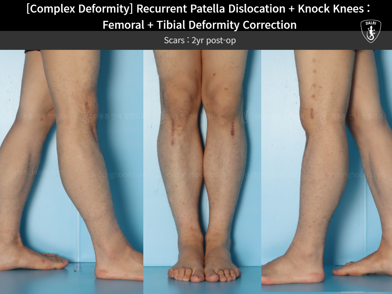 Before and after complex deformity, case 17435051, image 7, Dr. Donghoon institute (DALRI)