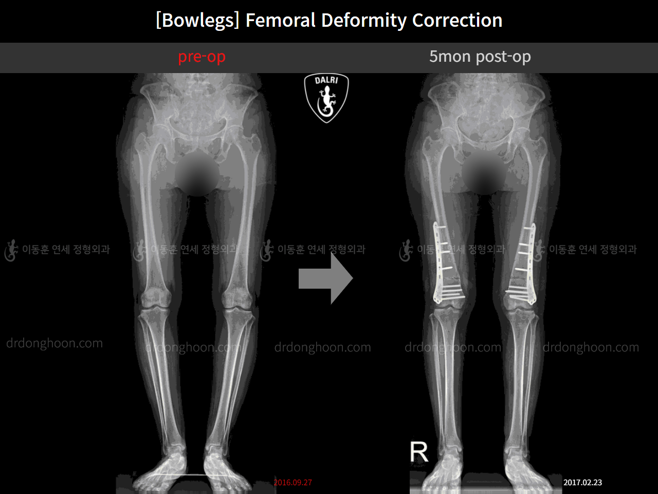 Before and after adult bowlegs, case 11379035, image 1, Dr. Donghoon institute (DALRI)
