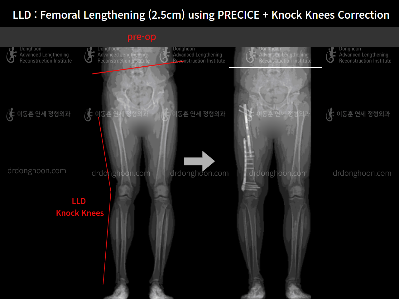 Before and after adult lld, case 9016415, image 6, Dr. Donghoon institute (DALRI)