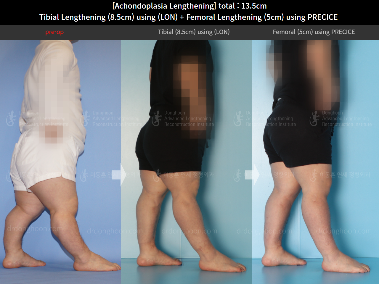 Before and after congenital condition, case 14993507, image 4, Dr. Donghoon institute (DALRI)