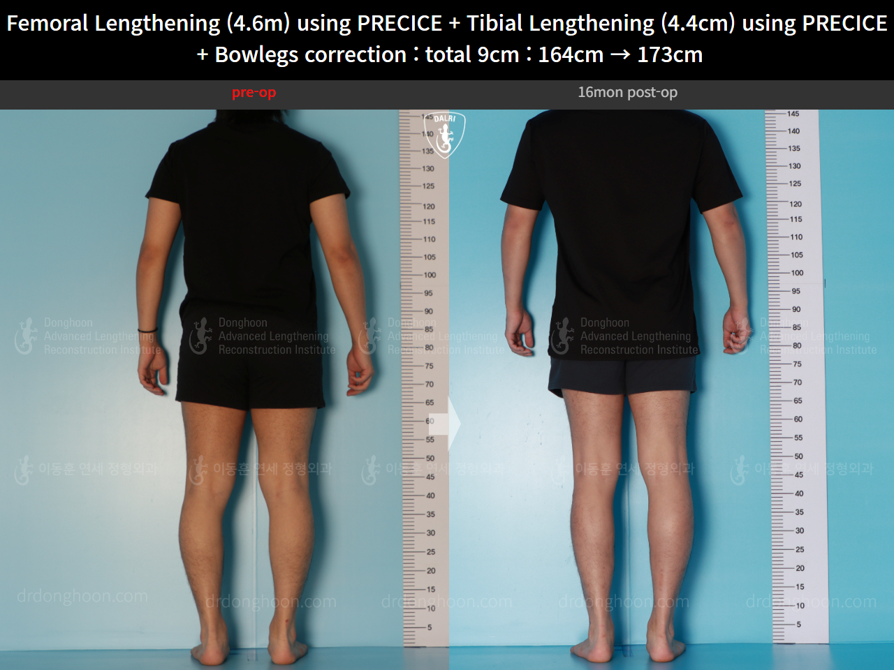 Before and after cll precice, case 16697524, image 4, Dr. Donghoon institute (DALRI)